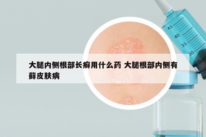 大腿内侧根部长癣用什么药 大腿根部内侧有藓皮肤病