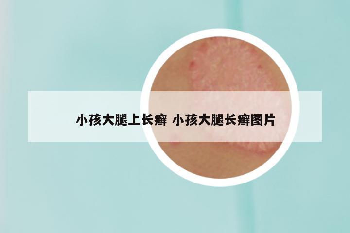 小孩大腿上长癣 小孩大腿长癣图片