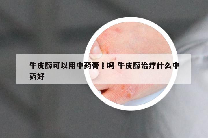 牛皮廨可以用中药膏捈吗 牛皮廨治疗什么中药好