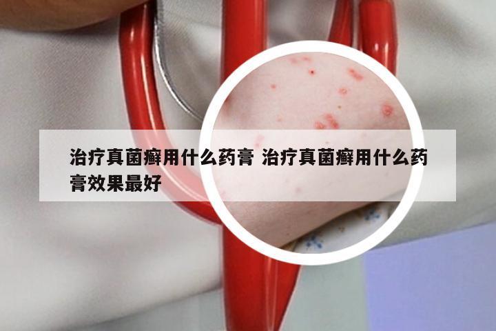 治疗真菌癣用什么药膏 治疗真菌癣用什么药膏效果最好