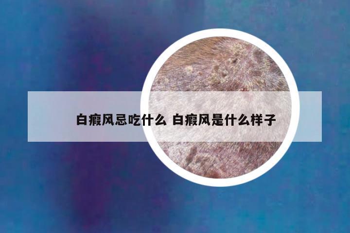 白瘕风忌吃什么 白瘕风是什么样子