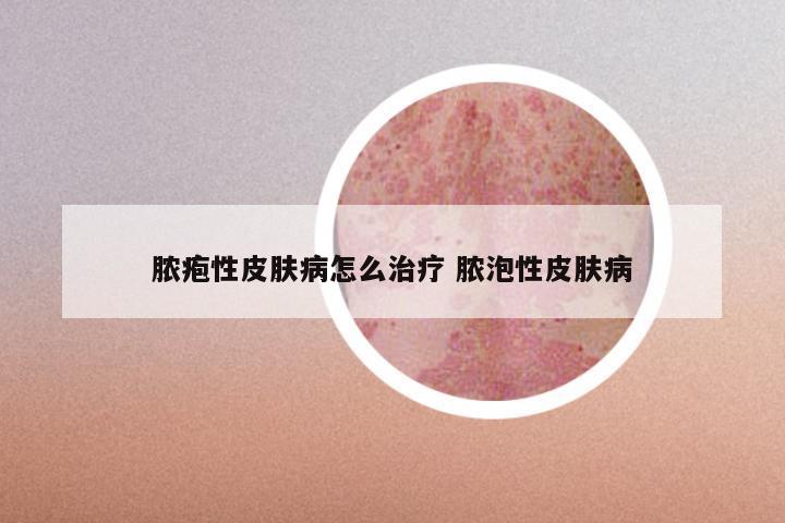 脓疱性皮肤病怎么治疗 脓泡性皮肤病