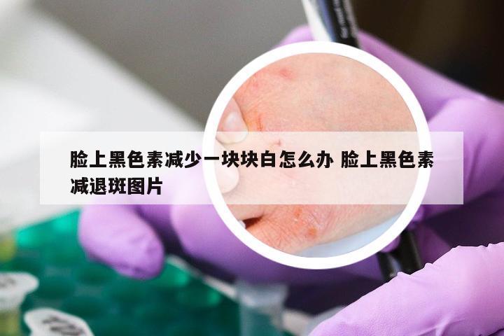 脸上黑色素减少一块块白怎么办 脸上黑色素减退斑图片