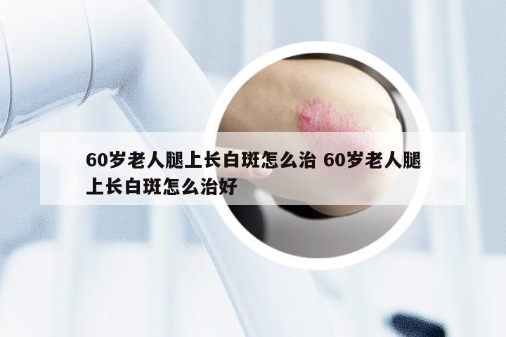 60岁老人腿上长白斑怎么治 60岁老人腿上长白斑怎么治好