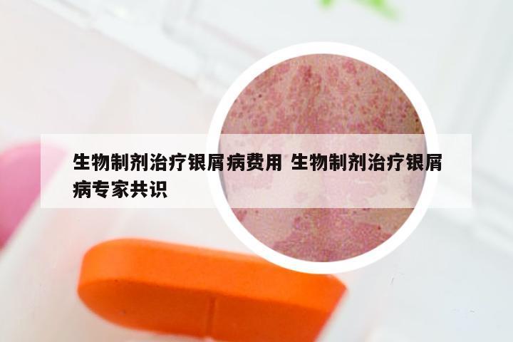 生物制剂治疗银屑病费用 生物制剂治疗银屑病专家共识