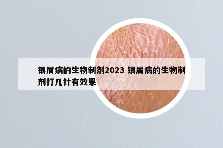 银屑病的生物制剂2023 银屑病的生物制剂打几针有效果