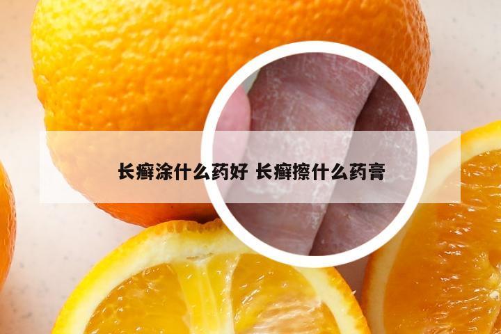 长癣涂什么药好 长癣擦什么药膏