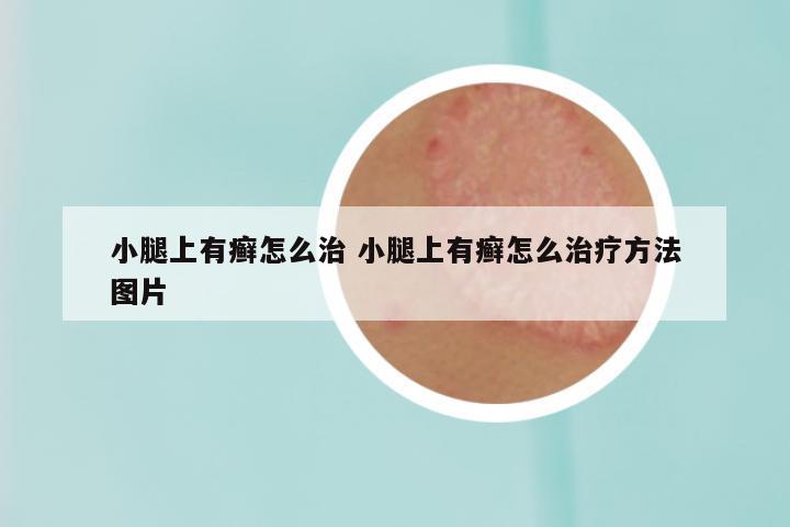 小腿上有癣怎么治 小腿上有癣怎么治疗方法图片