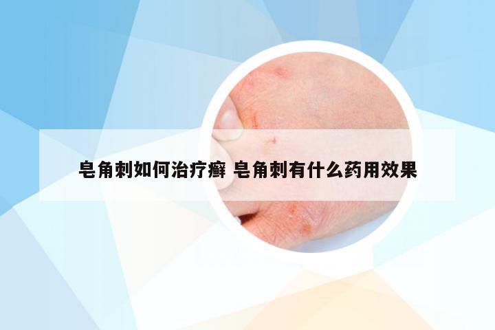 皂角刺如何治疗癣 皂角刺有什么药用效果