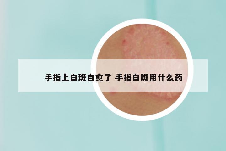 手指上白斑自愈了 手指白斑用什么药