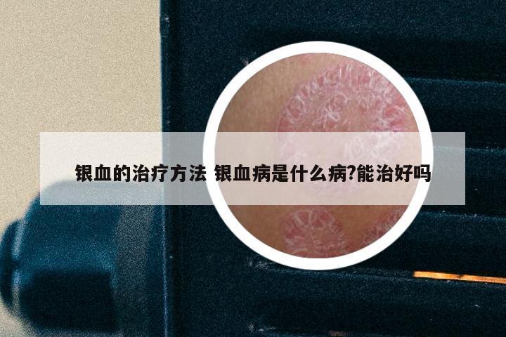 银血的治疗方法 银血病是什么病?能治好吗