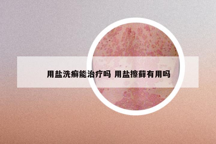 用盐洗癣能治疗吗 用盐擦藓有用吗