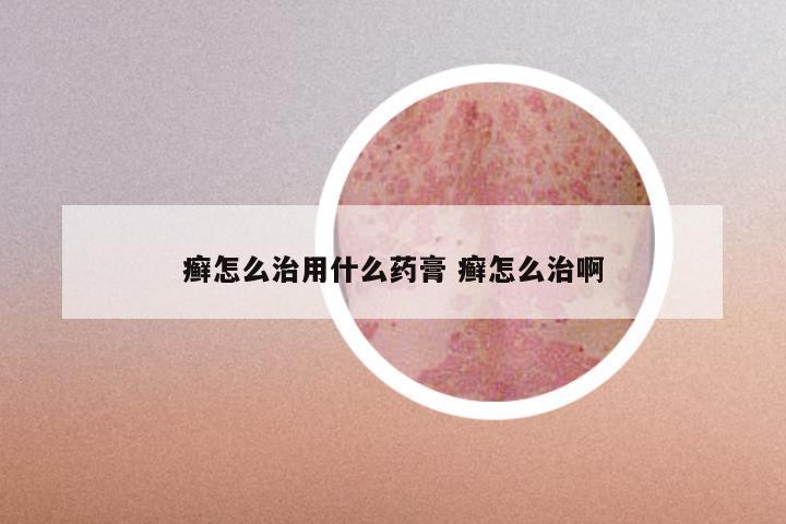 癣怎么治用什么药膏 癣怎么治啊