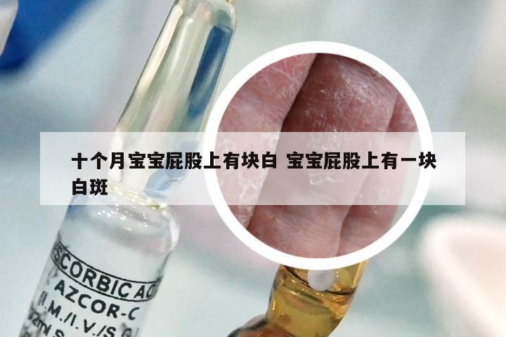 十个月宝宝屁股上有块白 宝宝屁股上有一块白斑