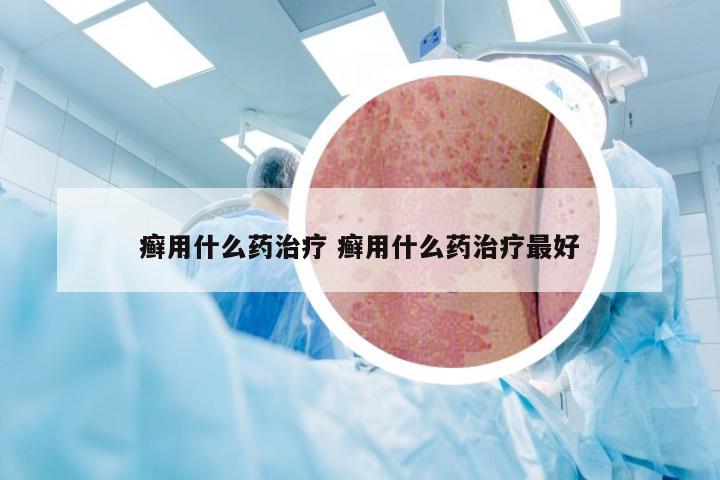 癣用什么药治疗 癣用什么药治疗最好