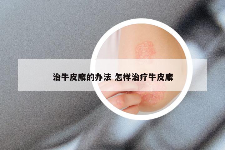 治牛皮廨的办法 怎样治疗牛皮廨