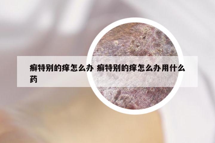 癣特别的痒怎么办 癣特别的痒怎么办用什么药