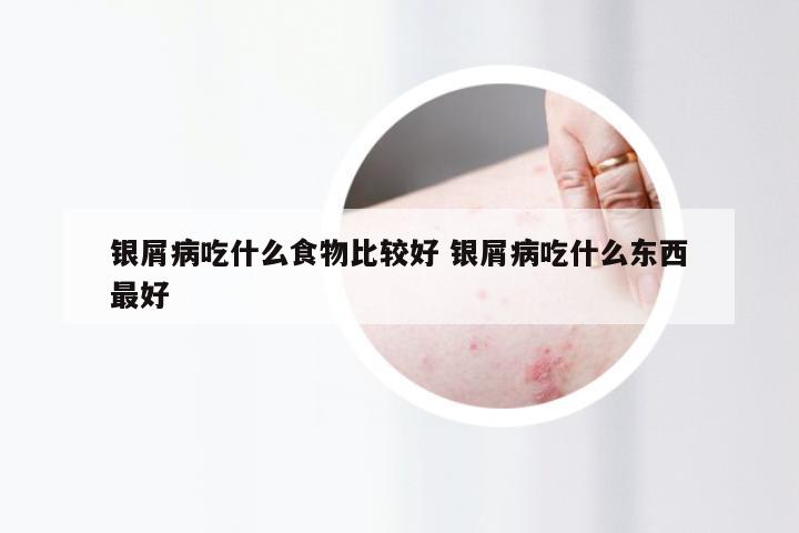 银屑病吃什么食物比较好 银屑病吃什么东西最好