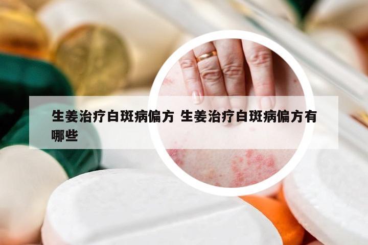 生姜治疗白斑病偏方 生姜治疗白斑病偏方有哪些