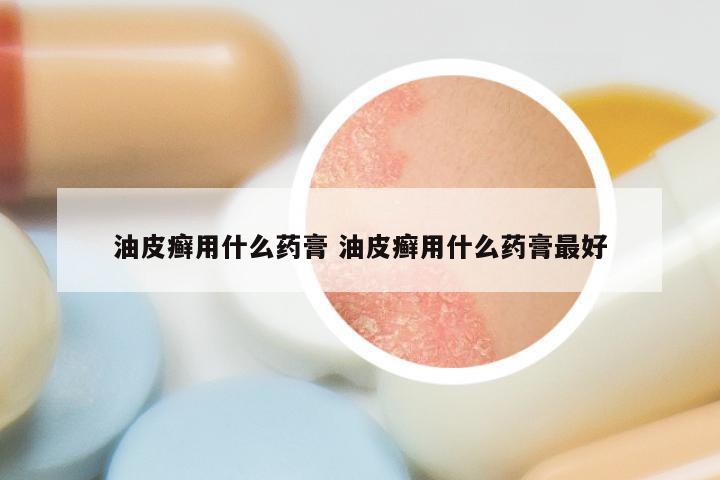 油皮癣用什么药膏 油皮癣用什么药膏最好