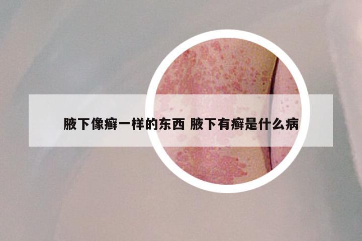 腋下像癣一样的东西 腋下有癣是什么病