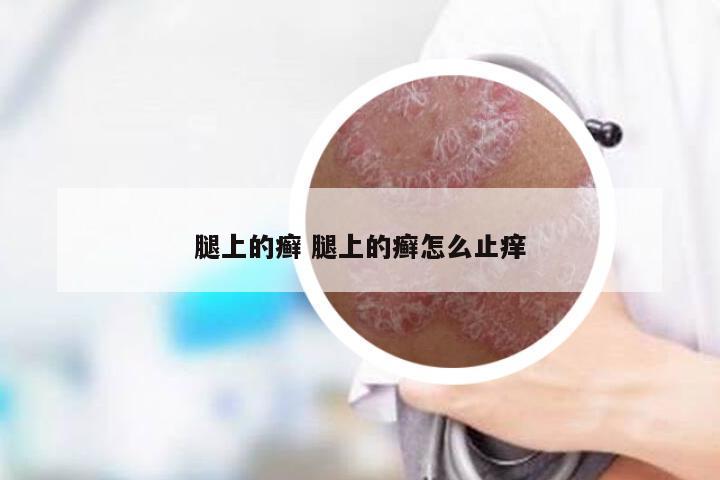 腿上的癣 腿上的癣怎么止痒