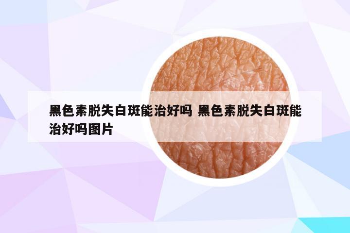 黑色素脱失白斑能治好吗 黑色素脱失白斑能治好吗图片