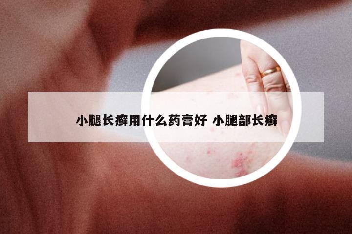 小腿长癣用什么药膏好 小腿部长癣