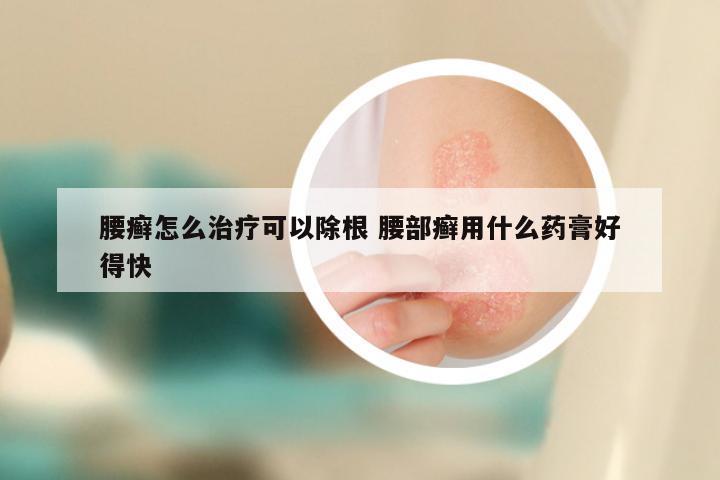 腰癣怎么治疗可以除根 腰部癣用什么药膏好得快