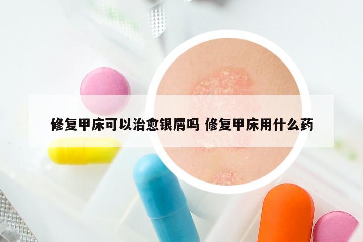 修复甲床可以治愈银屑吗 修复甲床用什么药