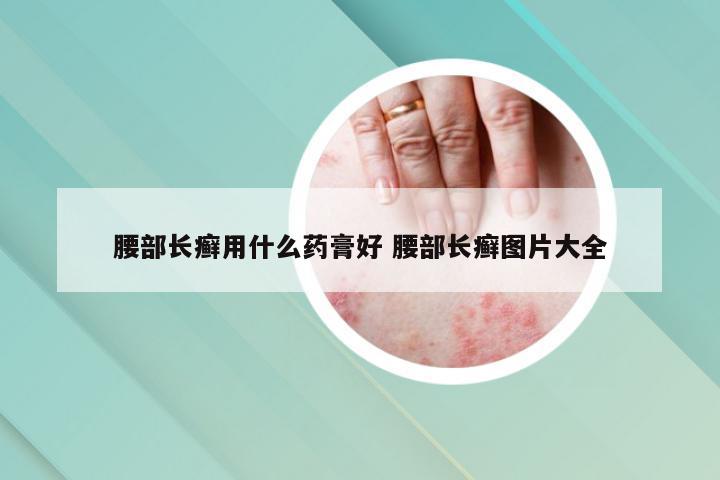 腰部长癣用什么药膏好 腰部长癣图片大全