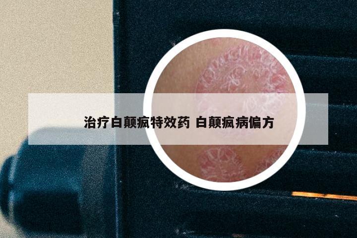 治疗白颠疯特效药 白颠疯病偏方