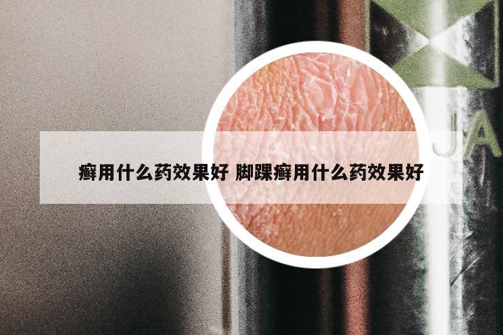 癣用什么药效果好 脚踝癣用什么药效果好