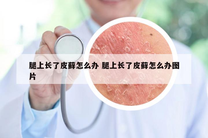 腿上长了皮藓怎么办 腿上长了皮藓怎么办图片