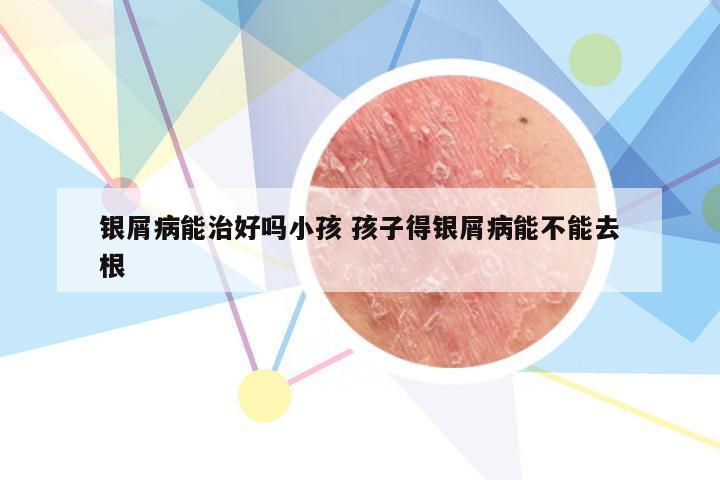 银屑病能治好吗小孩 孩子得银屑病能不能去根