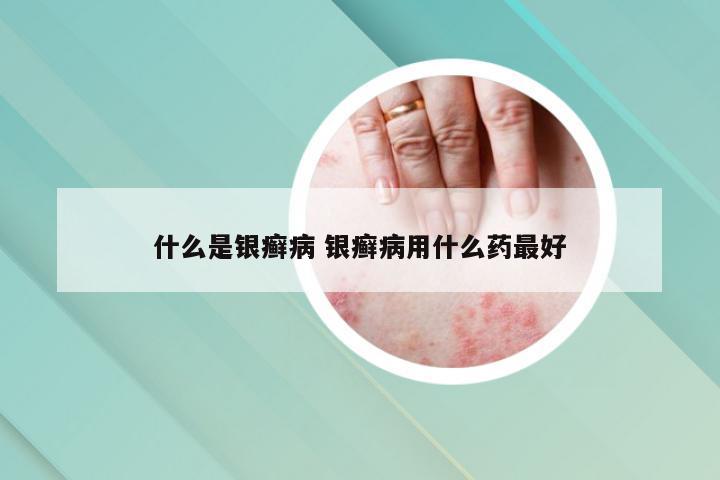 什么是银癣病 银癣病用什么药最好