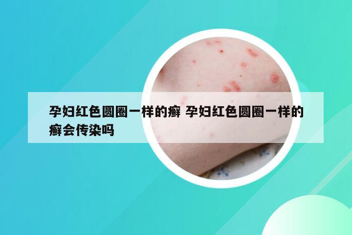 孕妇红色圆圈一样的癣 孕妇红色圆圈一样的癣会传染吗