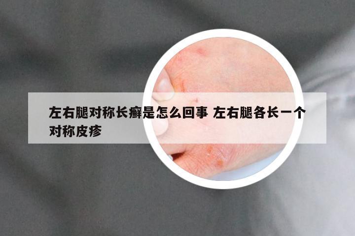 左右腿对称长癣是怎么回事 左右腿各长一个对称皮疹