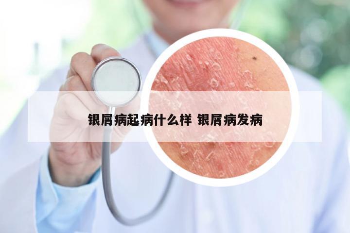 银屑病起病什么样 银屑病发病