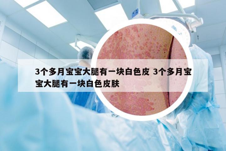 3个多月宝宝大腿有一块白色皮 3个多月宝宝大腿有一块白色皮肤