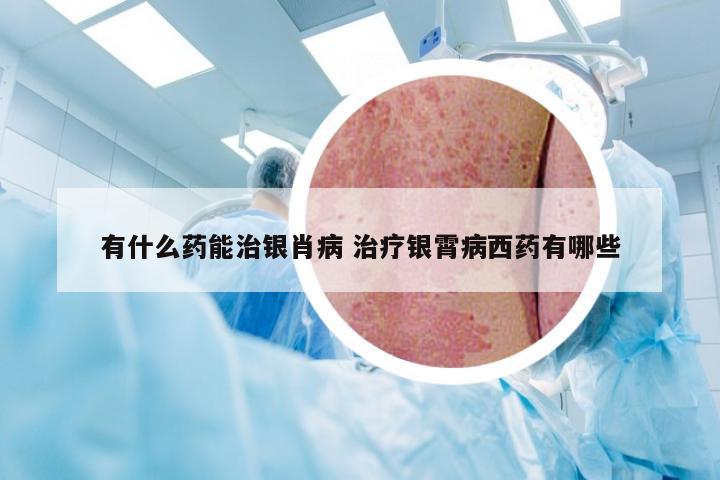 有什么药能治银肖病 治疗银霄病西药有哪些