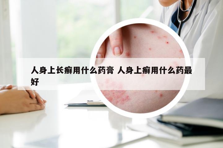 人身上长癣用什么药膏 人身上癣用什么药最好