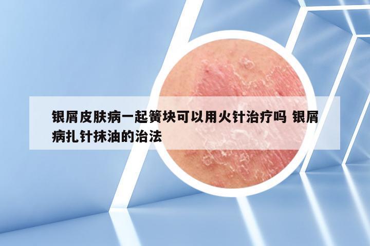 银屑皮肤病一起簧块可以用火针治疗吗 银屑病扎针抹油的治法