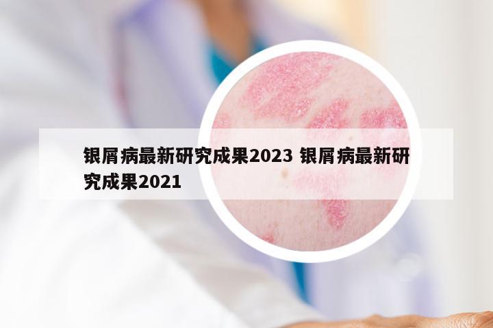 银屑病最新研究成果2023 银屑病最新研究成果2021