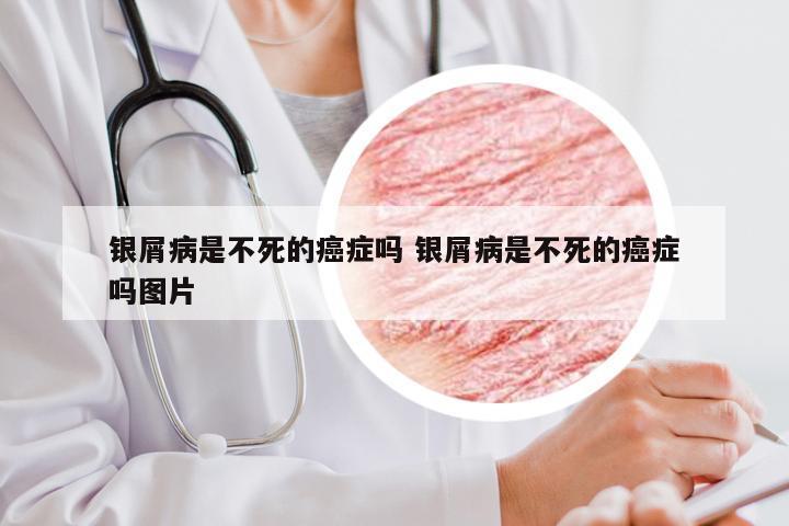 银屑病是不死的癌症吗 银屑病是不死的癌症吗图片