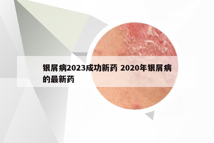 银屑病2023成功新药 2020年银屑病的最新药