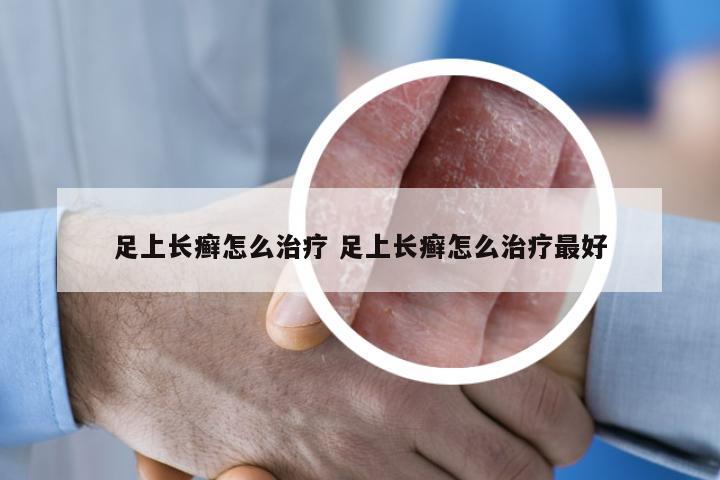 足上长癣怎么治疗 足上长癣怎么治疗最好