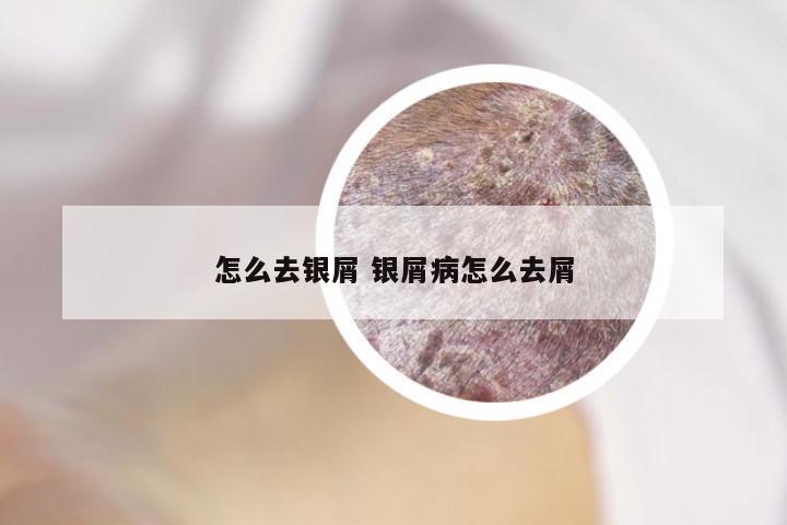 怎么去银屑 银屑病怎么去屑