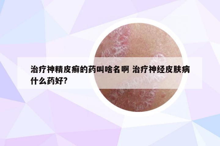 治疗神精皮癣的药叫啥名啊 治疗神经皮肤病什么药好?