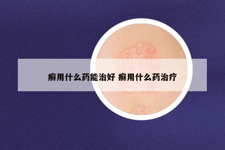 癣用什么药能治好 癣用什么药治疗